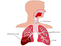 pneumonia